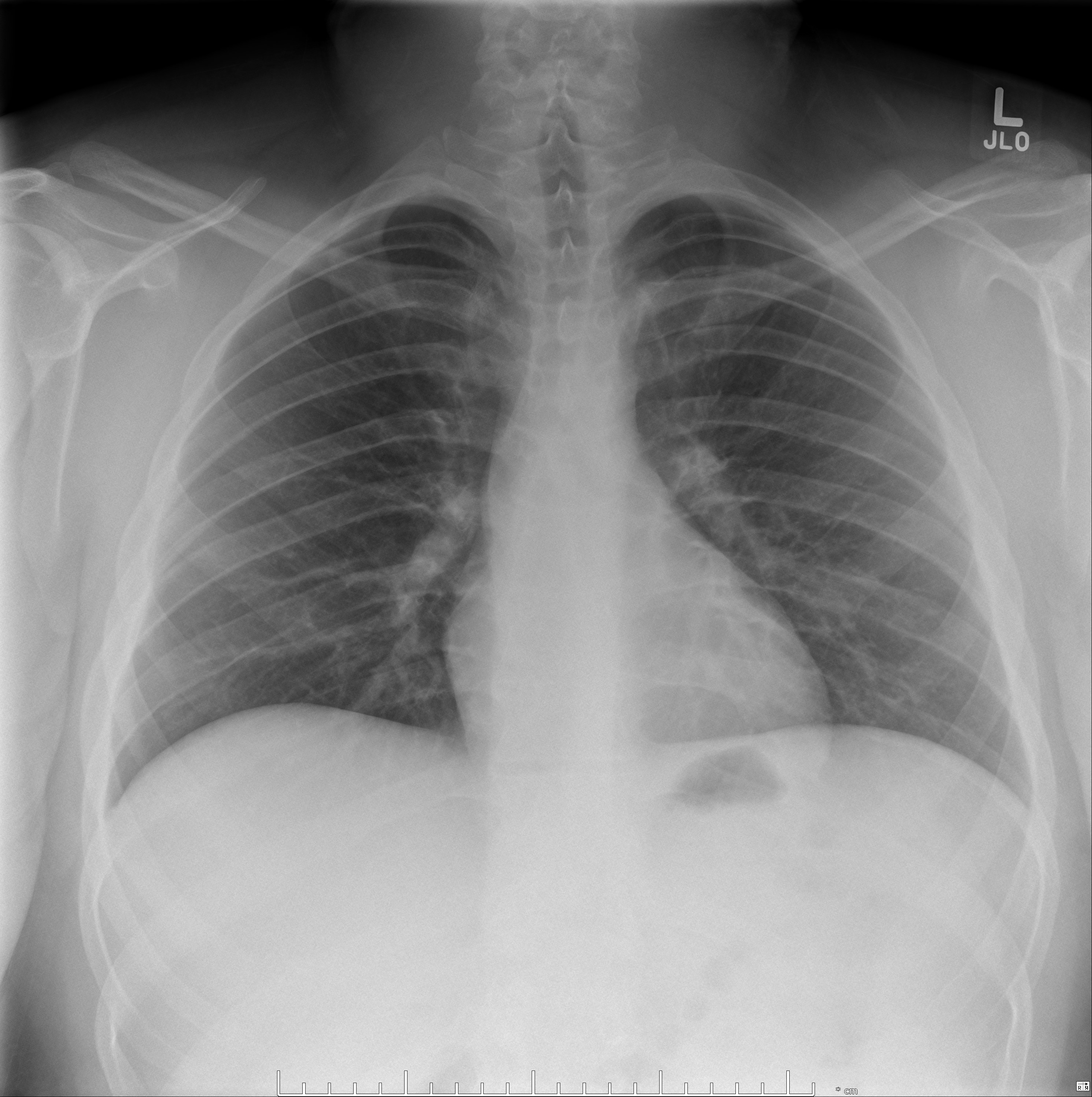 Medistinal lymphatic malformation | Image | Radiopaedia.org