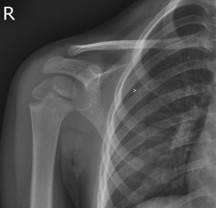 Osteochondroma - scapula | Image | Radiopaedia.org