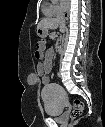 Incarcerated paraumbilical hernia | Image | Radiopaedia.org