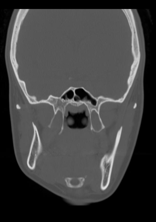 Unilateral mandibular condylar hyperplasia | Image | Radiopaedia.org