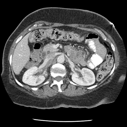 Spectrum of fibromuscular dysplasia - acute vertebral artery occlusion ...