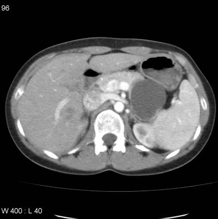 Serous cystadenoma of the pancreas - macrocystic | Image | Radiopaedia.org