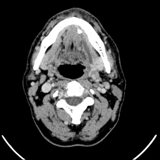 Wharton's duct stone | Image | Radiopaedia.org