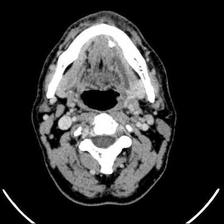 Wharton's duct stone | Image | Radiopaedia.org