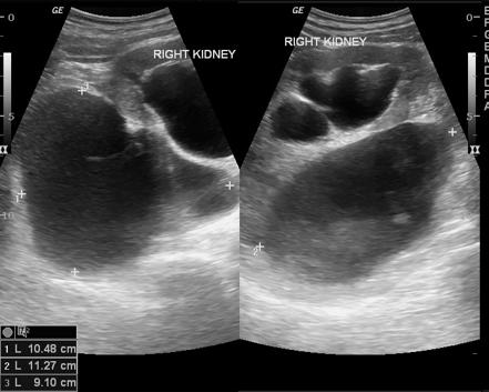 Urinoma Radiology Reference Article Radiopaedia Org