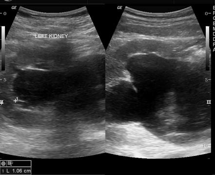 Urinoma | Image | Radiopaedia.org