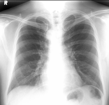 Right sided aortic arch | Radiology Case | Radiopaedia.org