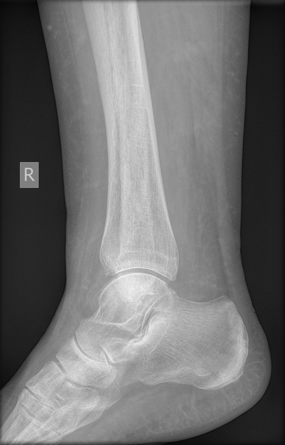 Trimalleolar ankle fracture with syndesmotic injury | Image ...