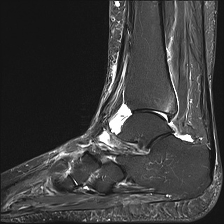 Trimalleolar ankle fracture with syndesmotic injury | Radiology Case ...