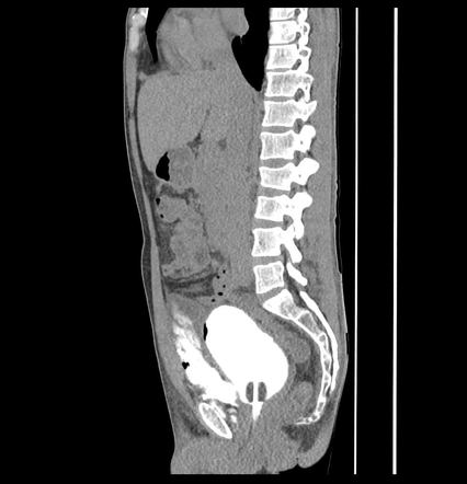 Extraperitoneal Bladder Rupture | Radiology Case | Radiopaedia.org