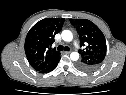 Extraperitoneal bladder rupture | Image | Radiopaedia.org