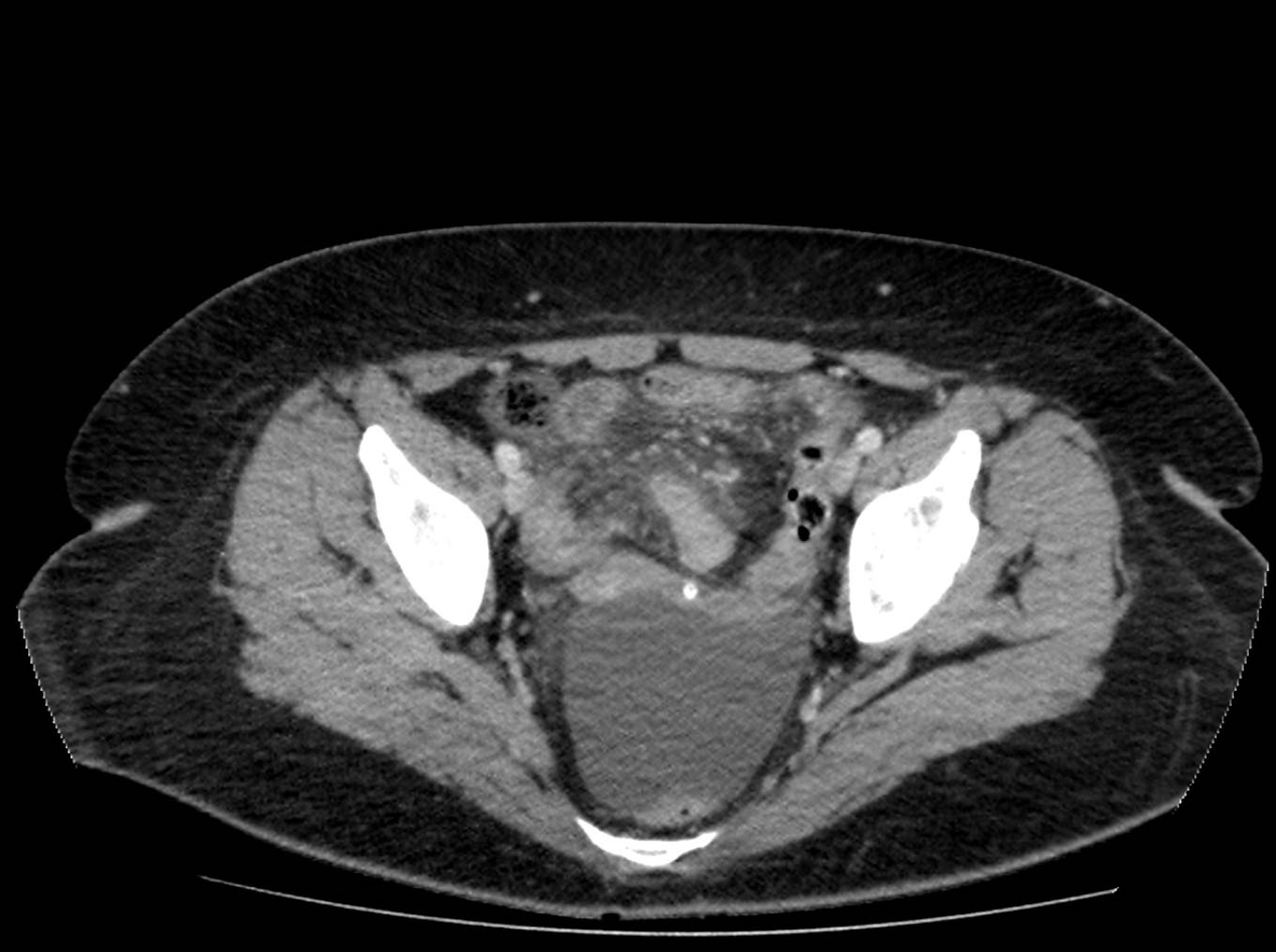 Internal Hernia With Bowel Ischemia Image 2940