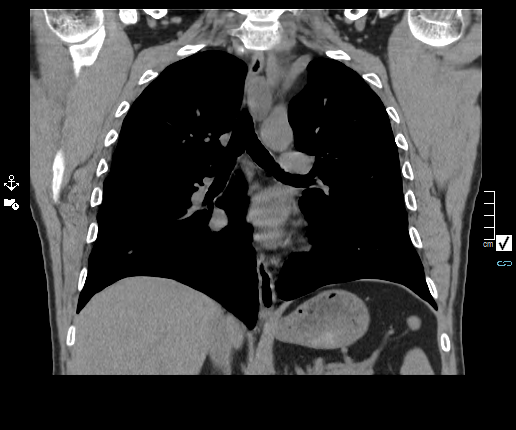 Vagus and recurrent nerve schwannomas | Image | Radiopaedia.org