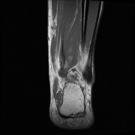 Accessory soleus muscle | Image | Radiopaedia.org