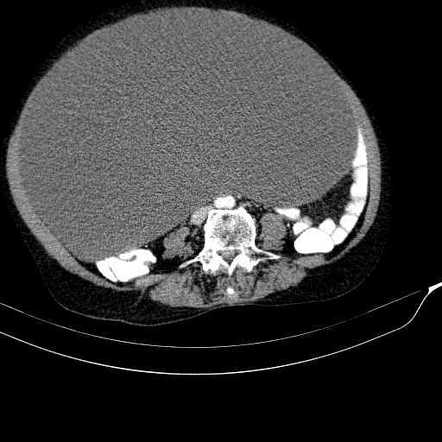 Giant mesenteric cyst | Radiology Case | Radiopaedia.org