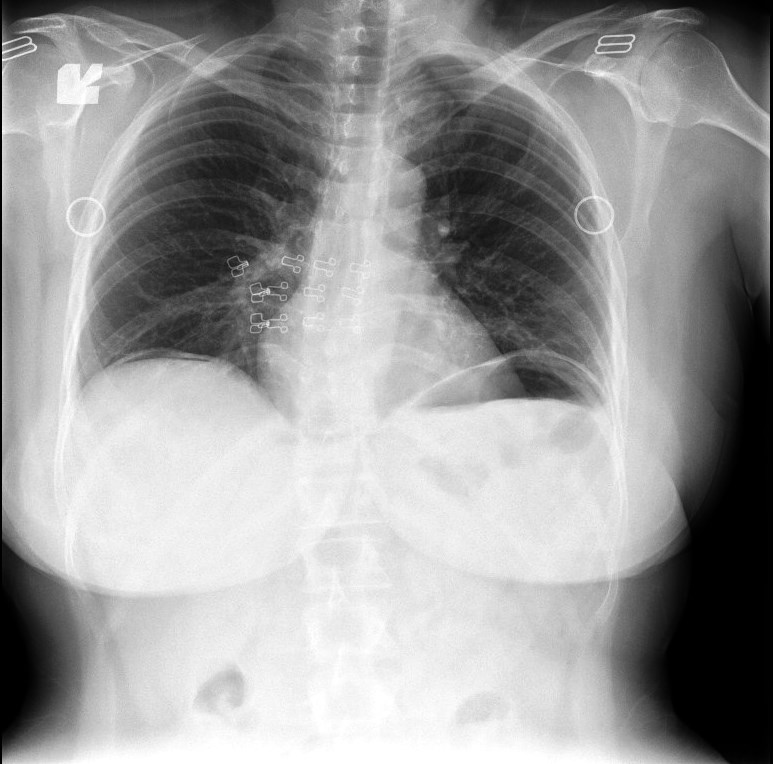 Perforated Peptic Ulcer X Ray