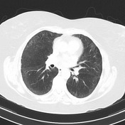 Methotrexate lung disease | Radiology Reference Article | Radiopaedia.org