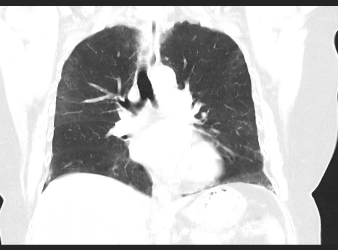 Methotrexate-induced Non-specific Interstitial Pneumonitis | Image ...