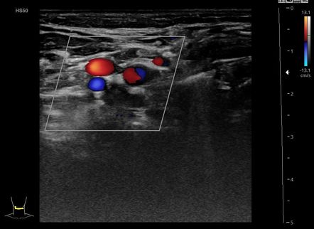 Central Venous Catheter-related Thrombosis 