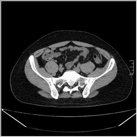 Epiploic appendagitis | Image | Radiopaedia.org