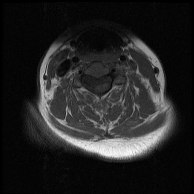 Intradural extramedullary arachnoid cyst - cervical spine, Radiology Case