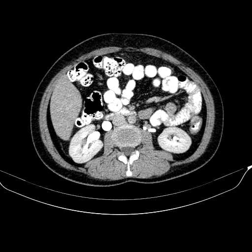 Blind-ending branch of a bifid ureter | Image | Radiopaedia.org