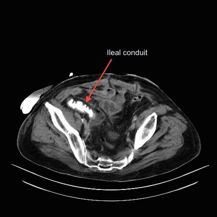 Pelvic abscess after urostomy | Image | Radiopaedia.org