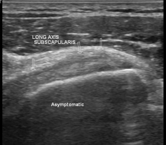 Subscapularis tendon tear | Image | Radiopaedia.org