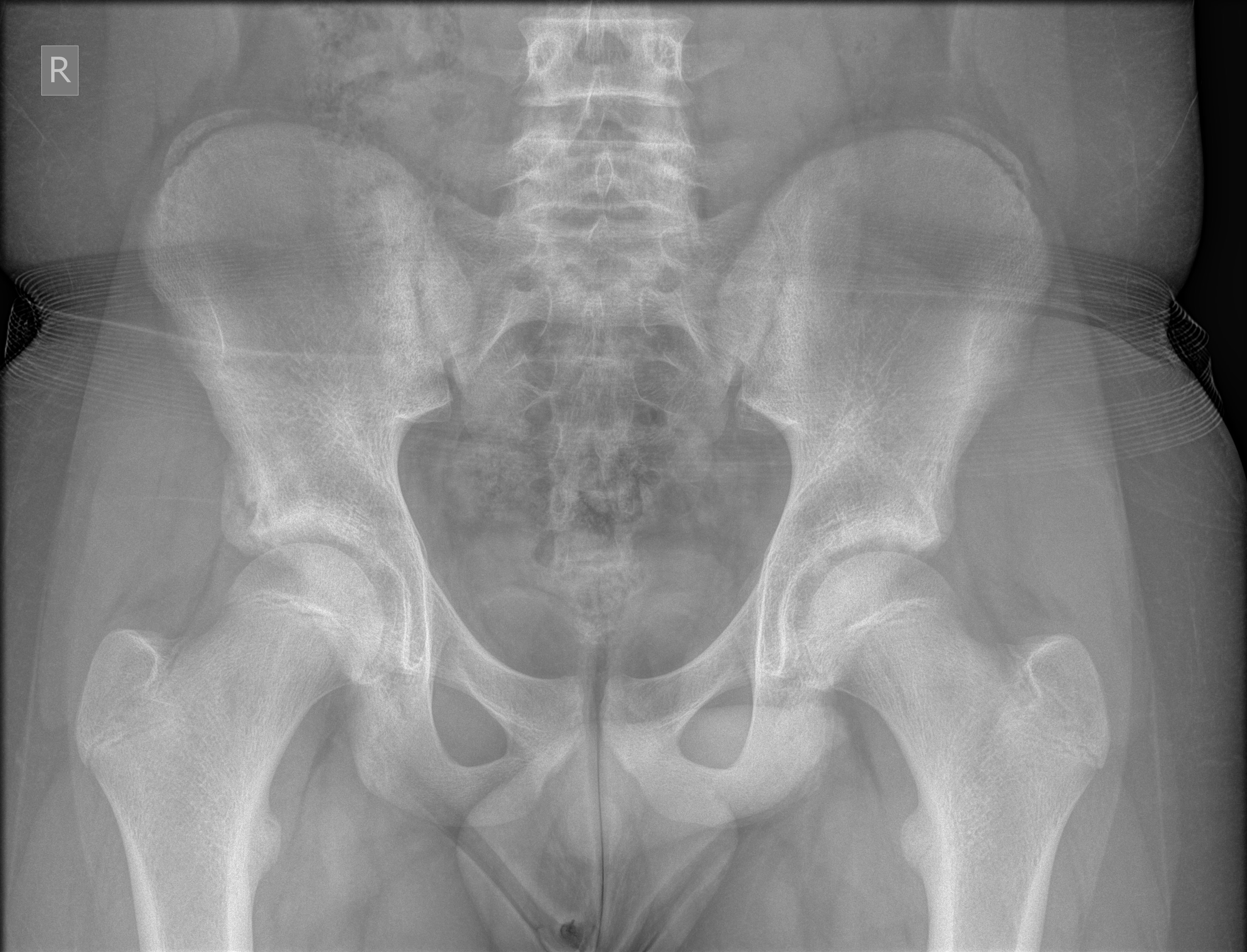 Anterior Inferior Iliac Spine Avulsion Fracture Image