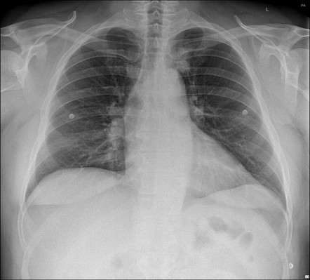 Left upper lobe adenocarcinoma | Radiology Case | Radiopaedia.org