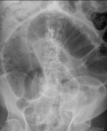 Sigmoid volvulus | Radiology Case | Radiopaedia.org