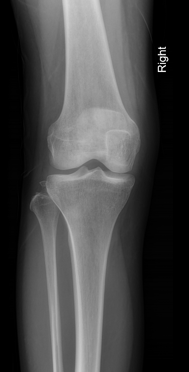 Fibular head avulsion fracture - old | Image | Radiopaedia.org