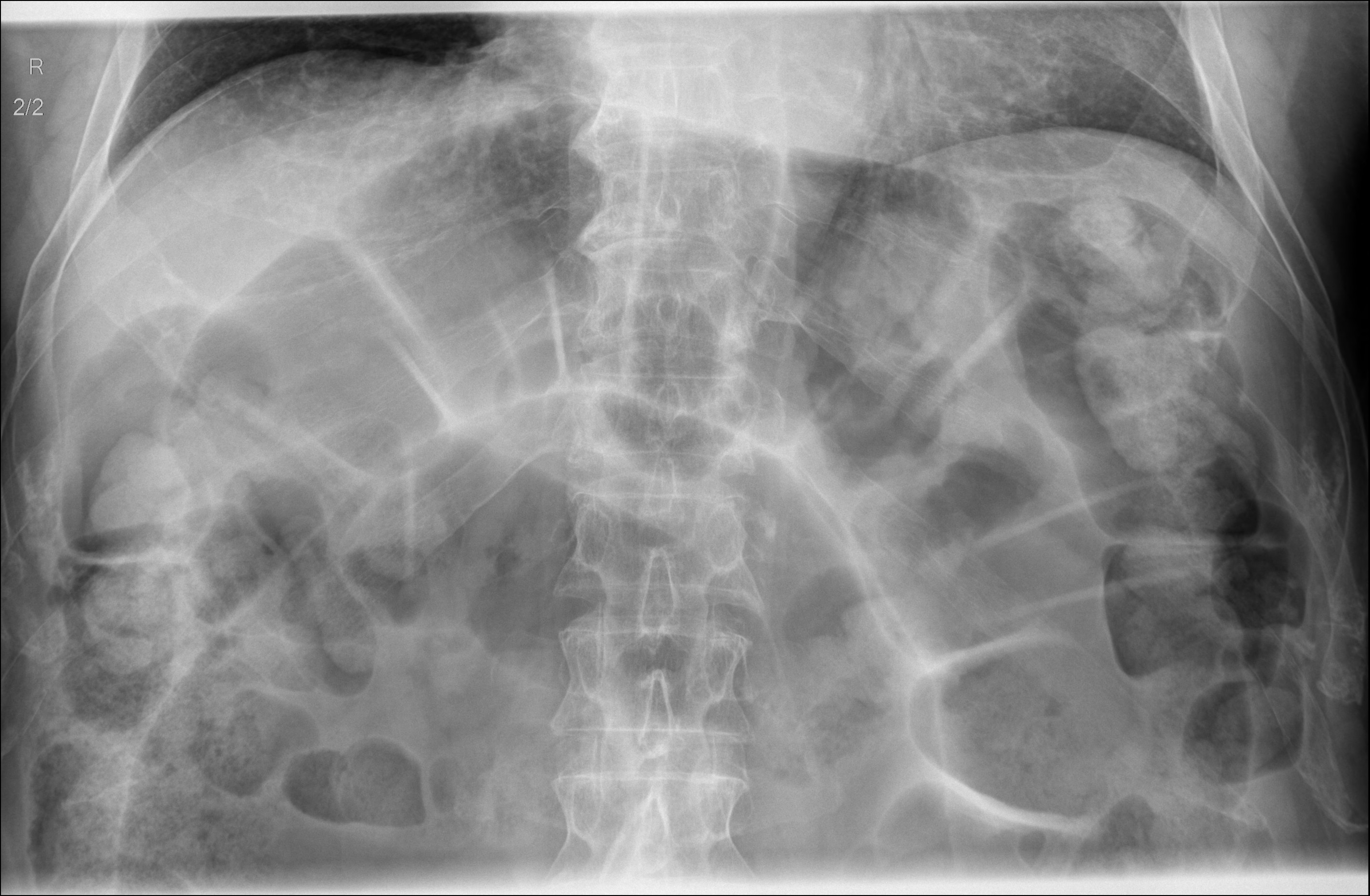 Sigmoid volvulus | Image | Radiopaedia.org