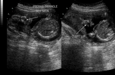 Fetal cleft lip | Image | Radiopaedia.org