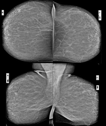 High-grade Ductal Carcinoma | Radiology Case | Radiopaedia.org