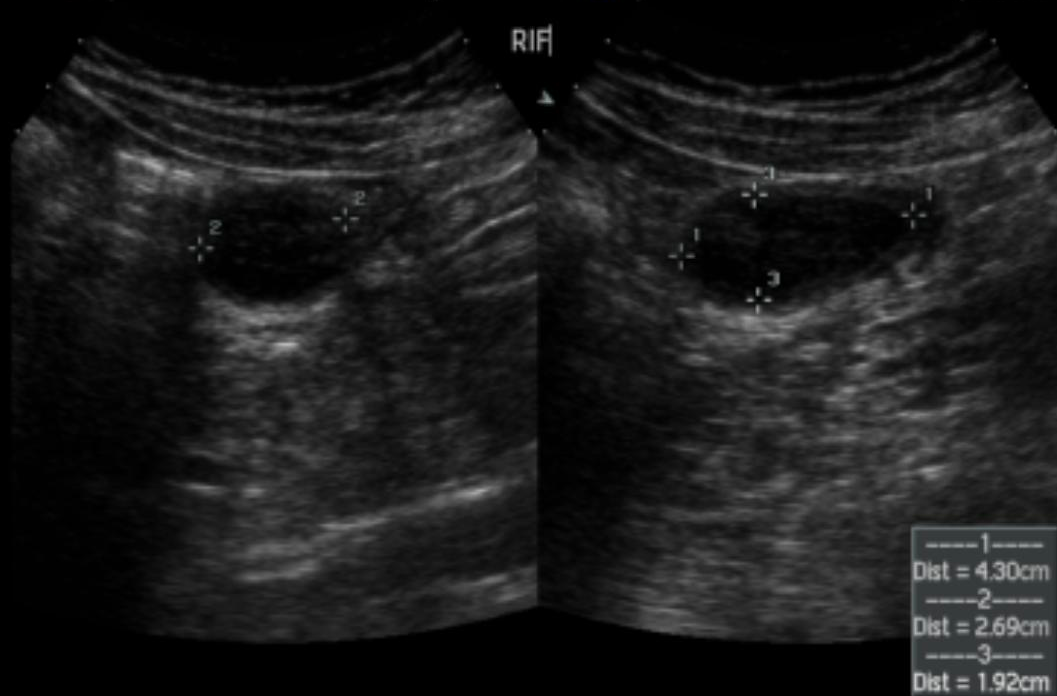 Meckel Diverticulitis Image