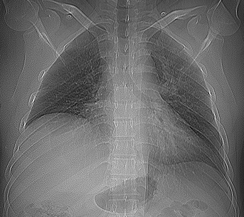 Pulmonary embolism with contralateral agenesis of pulmonary artery ...