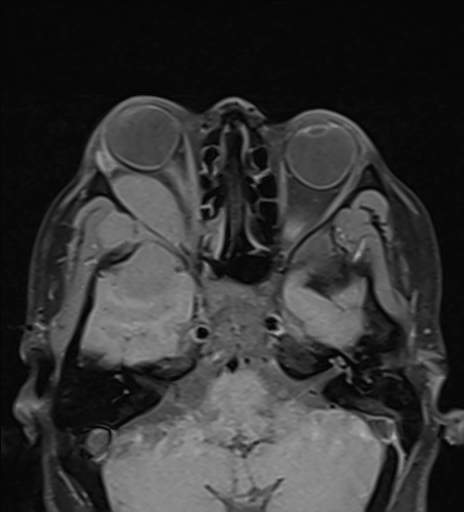 Spheno-orbital meningioma | Image | Radiopaedia.org