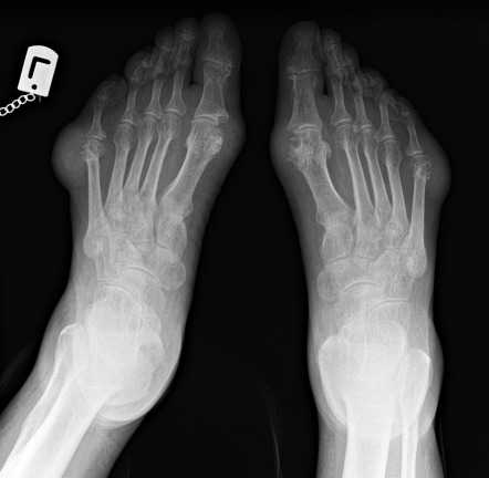 Gout | Radiology Reference Article | Radiopaedia.org