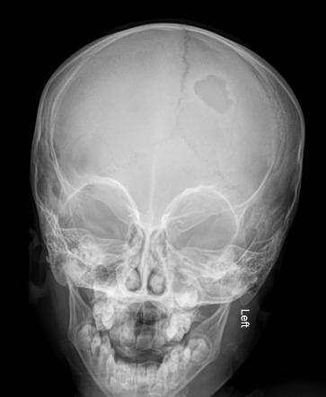 Langerhans cell histiocytosis | Radiology Case | Radiopaedia.org