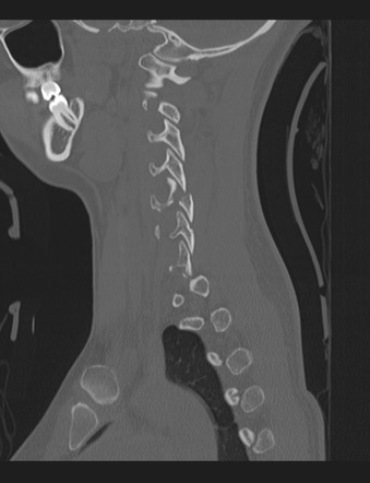 Facet joint fracture treated with ACDF and follow-up | Radiology Case ...