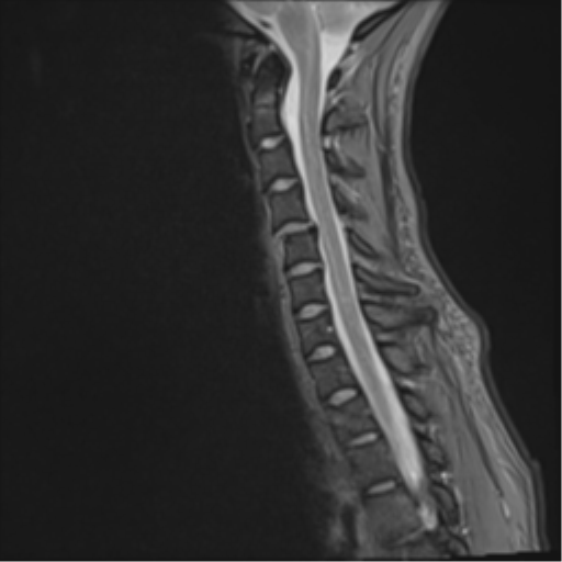 Facet joint fracture treated with ACDF and follow-up | Image ...