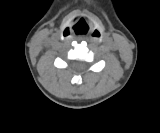 Facet joint fracture treated with ACDF and follow-up | Image ...