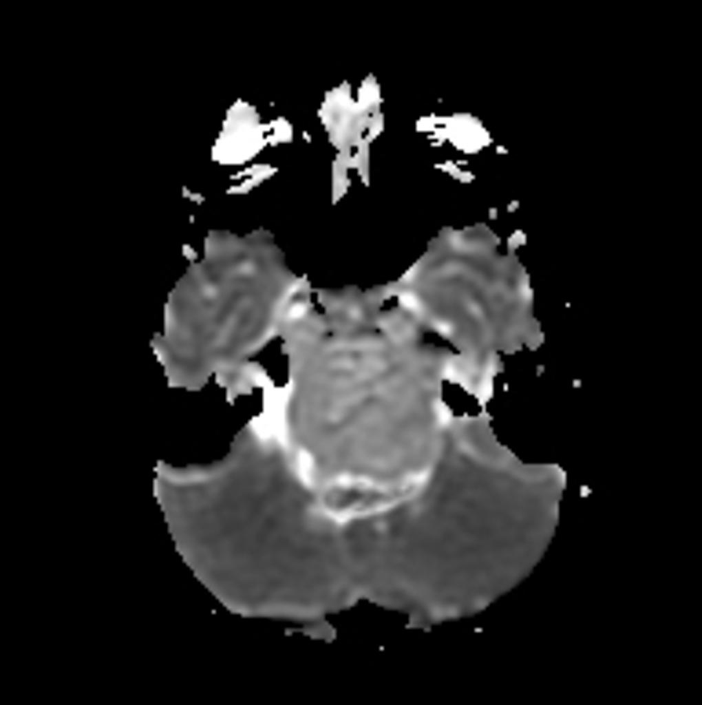 Chordoma | Image | Radiopaedia.org