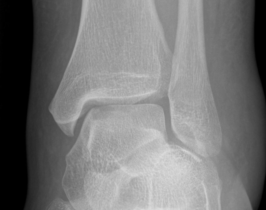 Talar osteochondral defect | Image | Radiopaedia.org