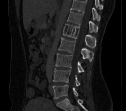 Corduroy sign (vertebral hemangioma) | Radiology Reference Article ...