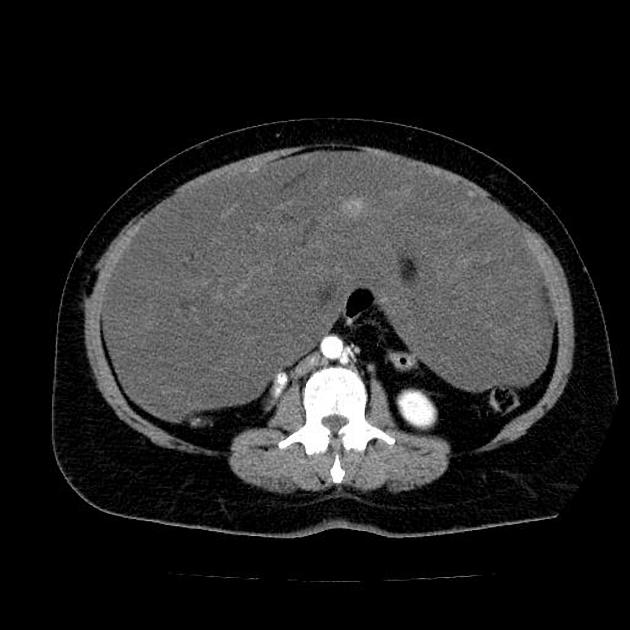 Benign Spindle Cell Tumor Abdominopelvic Radiology Case Radiopaedia Org