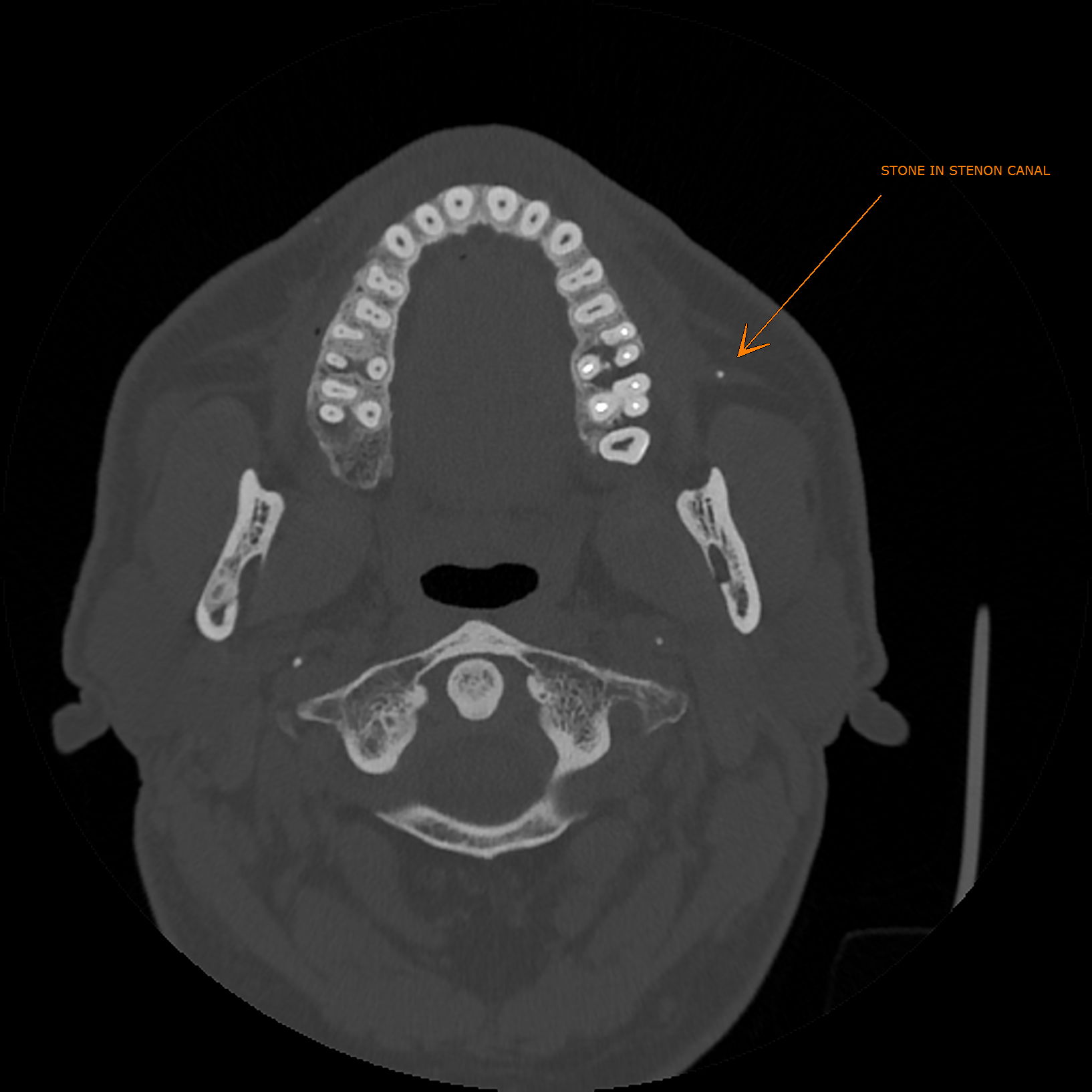 Parotid duct stone | Image | Radiopaedia.org