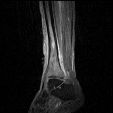 Fungal osteomyelitis | Image | Radiopaedia.org