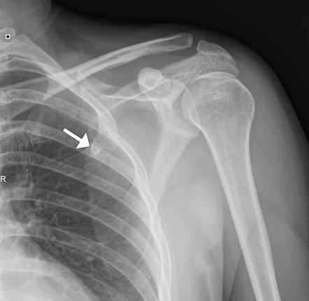 Osteochondroma - scapular | Image | Radiopaedia.org